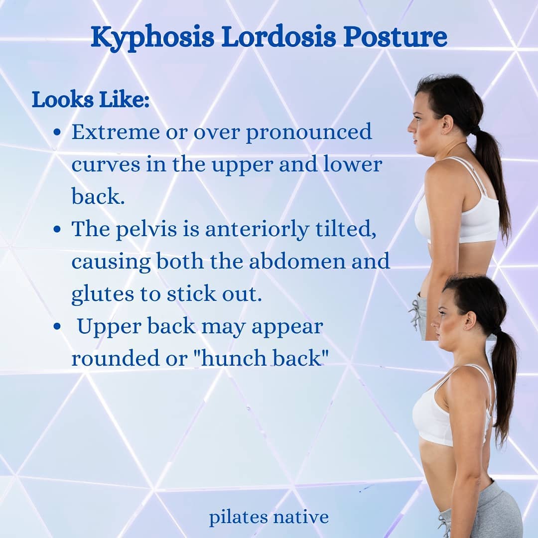 Standing Posture Kyphosis Lordosis Pilates Native 3591